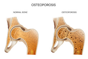Elder Care in Goodyear AZ: Reduce Fall Risk with Osteoporosis